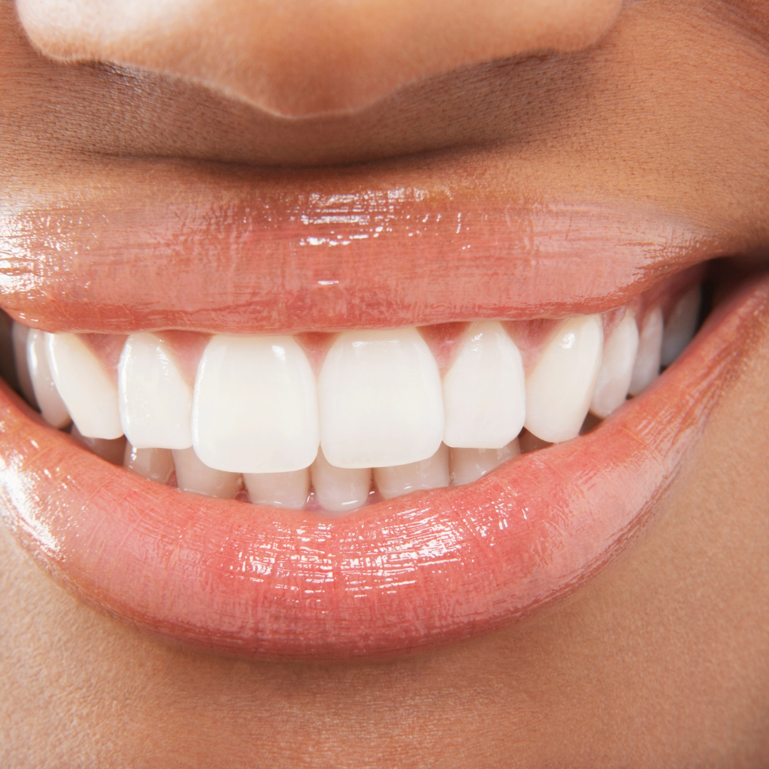 I Changed My Mind About Teeth Whitening. Here’s Why