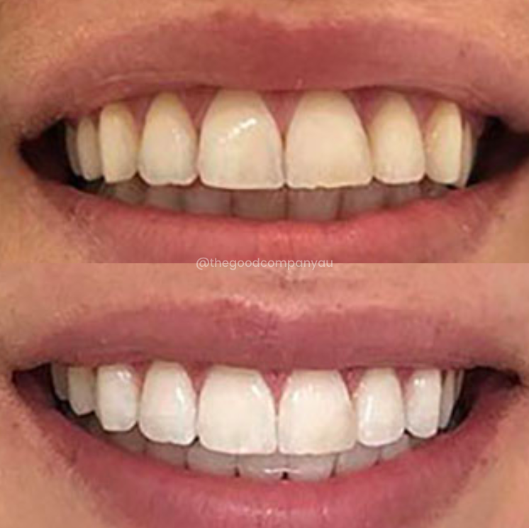 nHAp+ Teeth Whitening Serum
